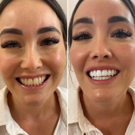 Benzi de Albire cu Cărbune Activ